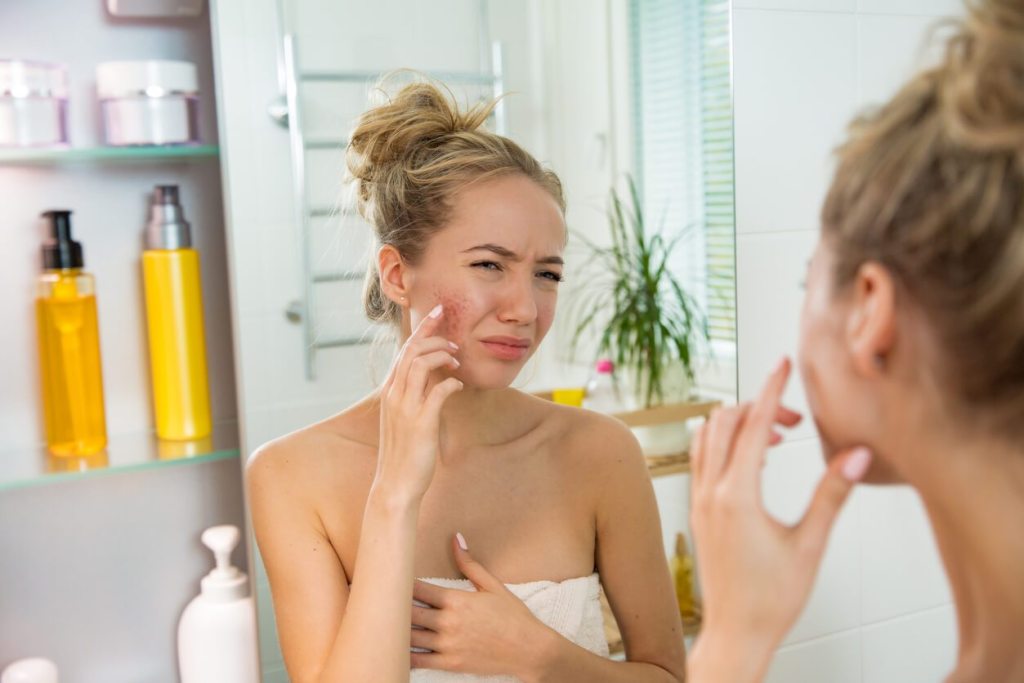 5 Home Remedies to say Goodbye to Acne problems